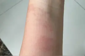 红斑狼疮是种什么病？形成的病因是什么？提醒：并非只有女性得图片