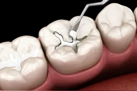 蛀牙后是补牙还是根管治疗图片