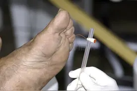 腿上出现两个表现，可能是糖尿病神经 病变！不要拖成糖尿病足图片