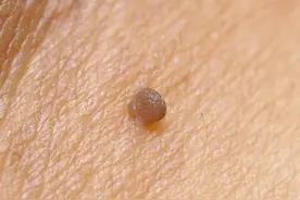 各种“疣”物知识总结，怎么安全快速去掉它们？图片