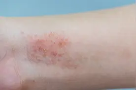 大腿内侧有红斑，你知道是什么原因吗？图片