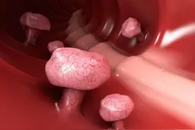 治疗 各种息肉 的一个妙方，适合直肠息肉、声带息肉、宫颈息肉图片