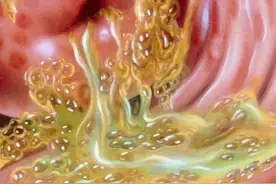 阴道毛滴虫病-私密处的传染病，小心中招图片