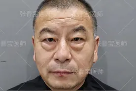 53岁第一次做微创去眼袋，术中有点疼，首次公开手术全过程图片