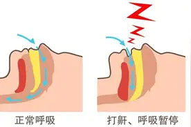 医生：晚上睡觉嘴巴发干，或是3种疾病警报，很多人还以为是缺水图片