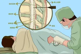 麻醉规培考试——蛛网膜下腔阻滞（腰麻）图片