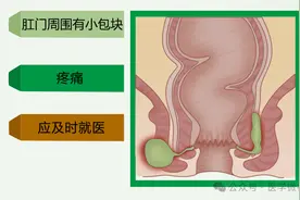 肛周脓肿这种诱发因素最常见，很多人都会碰到，别不当一回事！图片