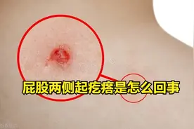 屁股两侧起疙瘩是怎么回事图片