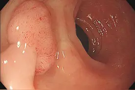 肠息肉是定时炸弹吗？医生告诉你，这几种类型息肉建议切除图片