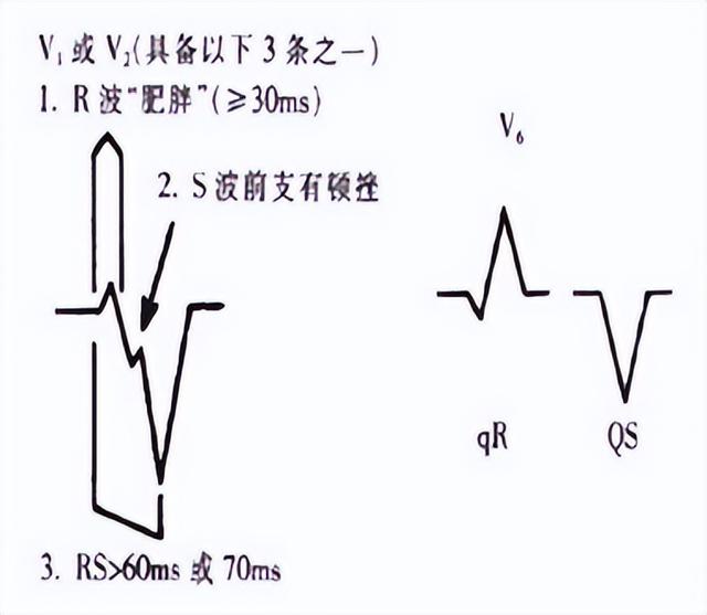 室性心动过速的体表心电图鉴别诊断