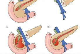 文献学习：慢性胰腺炎（CP）的手术时机与手术方式图片