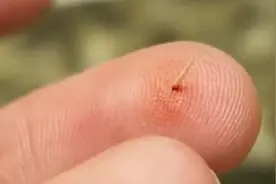 不小心将木刺扎到手上，别急着活动手指，简单几步挑出刺图片