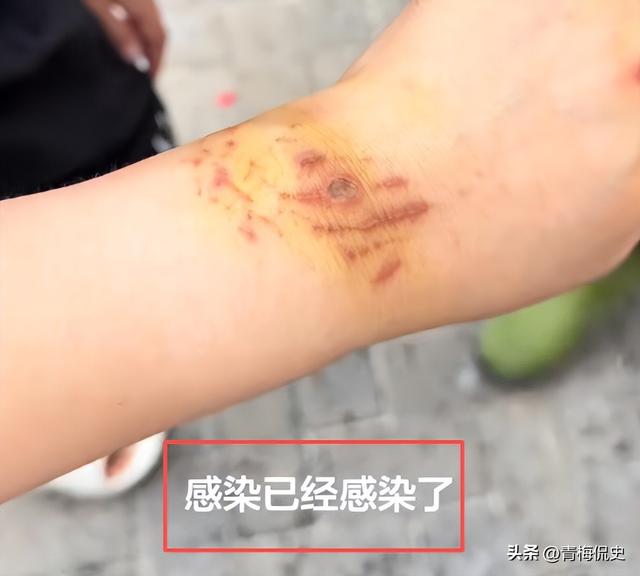 生理期潜水被鲨鱼咬伤后续：女子露面透细节，仍在感染中，已就医