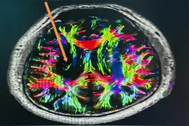 神奇的“移花接木”！山东省立第三医院成功开展健侧颈7神经移位术，“唤醒”脑出血患者偏瘫的肢体图片