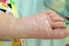 宝宝皮肤发生了什么------带你了解几种新生儿常见皮肤问题图片