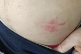 带状疱疹，可不只是小水泡，尤其是出现在特定部位，危害很大！图片