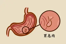 怎样的胃息肉才要切?不切会发展为胃癌吗？图片