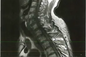 急性脊髓炎——病因与发病机制，病理，临床表现图片