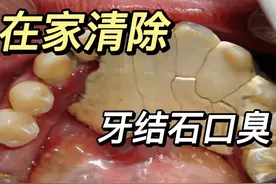 牙齿里的小黑石头又脏又臭？学会这3招，彻底清除牙结石口臭!图片