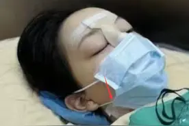 曝王菲女儿李嫣第4次手术，公开术后照片惹心疼，嘴巴缠满纱布图片