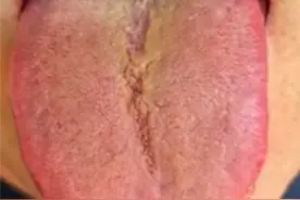 阴虚加湿热？那到底六味地黄丸合适，还是龙胆泻肝丸合适？图片
