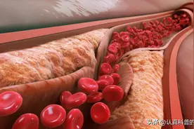 有颈动脉【低/无回声】斑块，“低密度”≥2.6，就得考虑吃他汀！图片