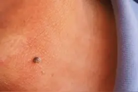 脖子和腋下的小肉粒是什么？能直接用手揪掉吗？看完涨知识了！图片