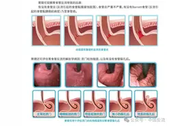 为啥这种检测被称为胃食管反流病检查的“金标准”？图片