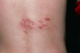 50 岁以上要打带状疱疹疫苗吗？保护期多久？权威建议来了图片