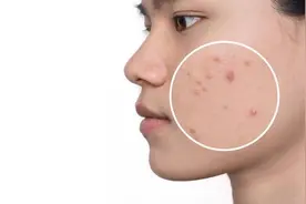 危险三角区挤痘会有什么后果？图片