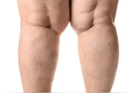 大腿外侧疼痛，需小心这3种病，不要以为，忍一忍就行图片