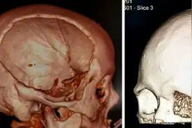 揭秘颅骨修补，你想知晓的都在这里图片