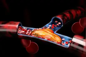 “血管早衰”的6个信号，别忽视这些身体变化，或是心梗、脑梗的前兆图片