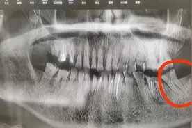 福州大叔牙痛到脸都麻了！这种痛别忽视，严重可致脏器衰竭→图片