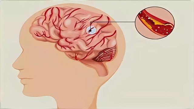 加速脑梗塞的原因：喝酒仅排第3，排第1的，很多老人都在做