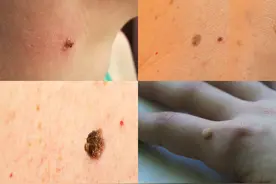 身上的这种小红点是病毒感染，小心越长越多图片