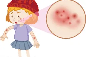 你了解皮炎吗？图片