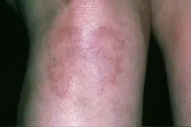 网传周海媚患红斑狼疮，什么是红斑狼疮，为什么会致命及流产，怎样治疗?图片