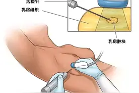 乳腺肿物活检的安全性如何图片