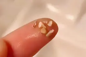 “牙结石”可以自己抠掉吗？教你几招，轻松清理牙缝脏东西图片