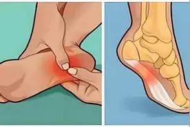 脚面突然疼得走不了路？快看看这[6]个原因！图片