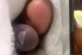 两岁男孩“摸鱼”感染病菌，伤情严重可能截肢！ICU治疗已花八万图片