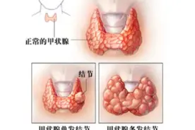 帮你分清甲状腺结节和甲状腺肿大，看完就明白了！图片
