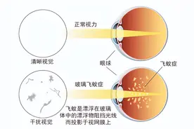 上海眼科医生：白内障术后出现黑影飘动，和白内障手术有关系吗？图片