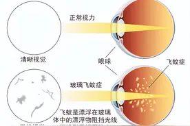 上海眼科医生：白内障术后出现黑影飘动，和白内障手术有关系吗？图片