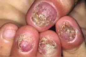 灰指甲的病因与治疗图片
