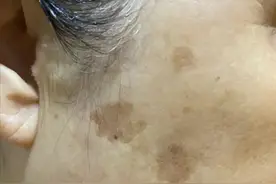 为什么老人身上爱长斑？远离这5个习惯，或能减轻老年斑图片