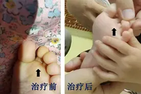 1岁宝宝脚趾深度糜烂，竟因大人传染足癣！家长需警惕图片
