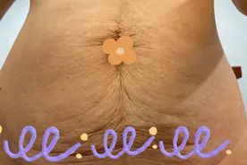 我经历了腹壁整形术后，用几张照片“真实的”记录下了全过程。图片