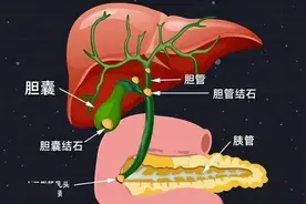 这个梅子用了3个月，4年胆囊息肉消灭了，立秋将胆囊疾病斩草除根图片